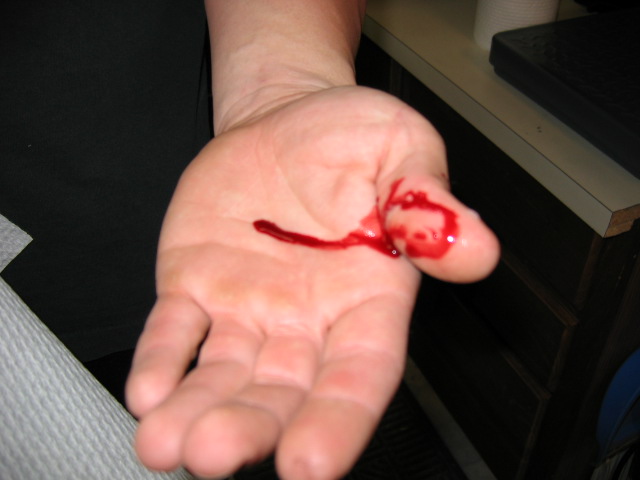 Snake bite